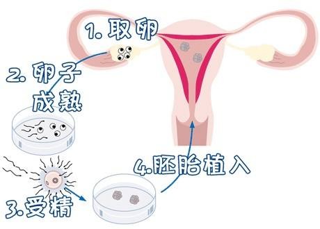 反复流产